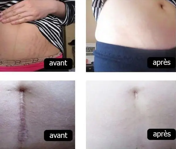 Crème Anti Vergetures & Cicatrices Efficace – Image 4