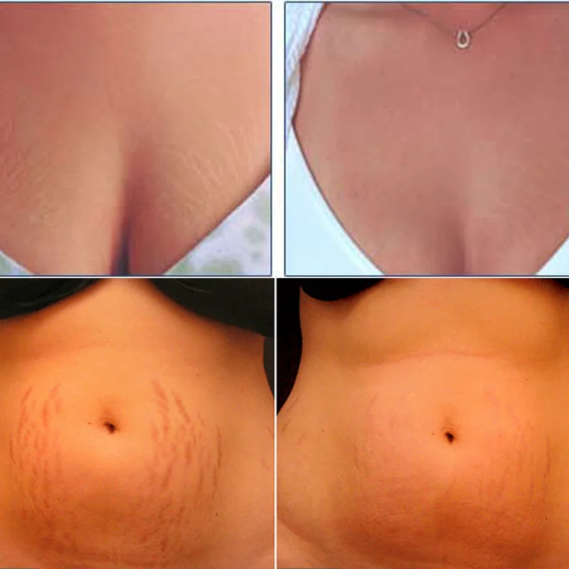 Crème Anti Vergetures & Cicatrices Efficace – Image 3